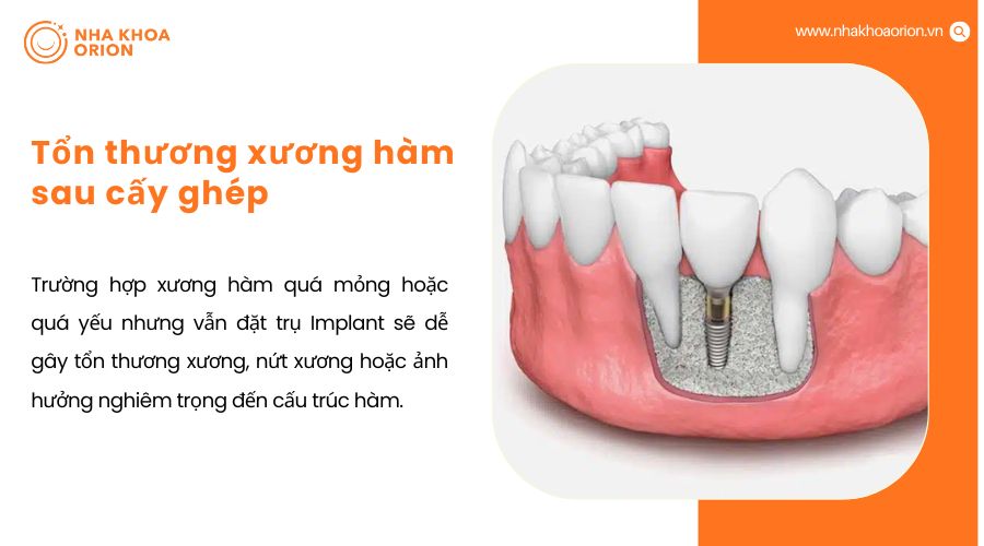 Tổn thương xương h&agrave;m sau cấy gh&eacute;p
