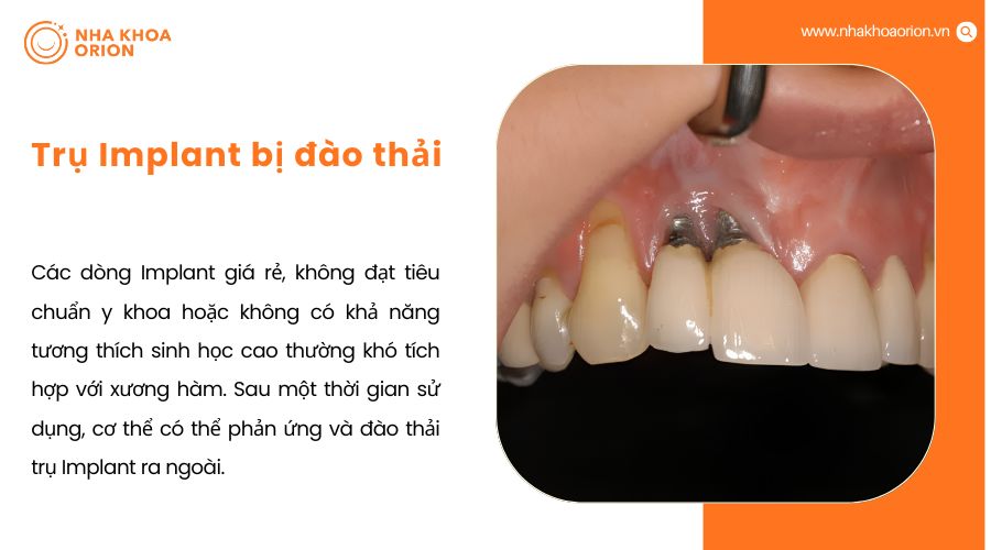 Trụ Implant bị đ&agrave;o thải