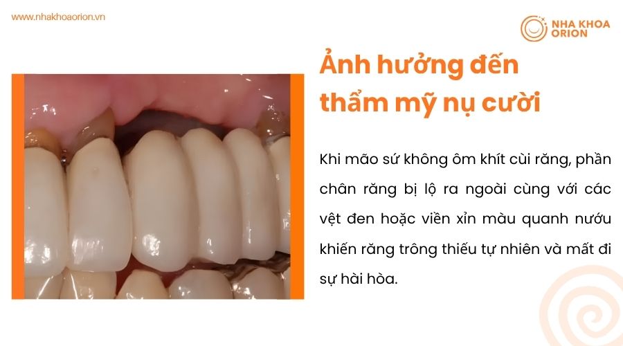 Ảnh hưởng đến thẩm mỹ nụ cười