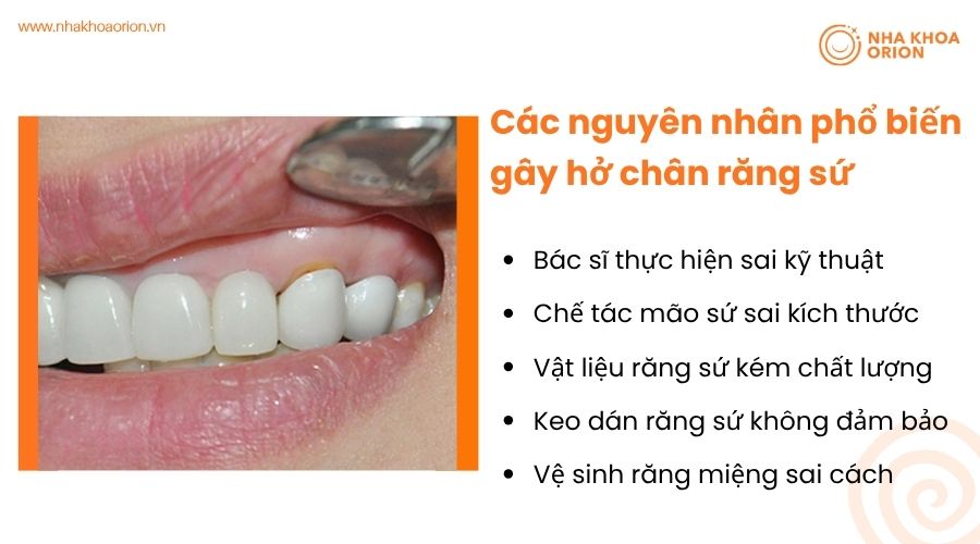Các nguyên nhân phổ biến gây hở chân răng sứ