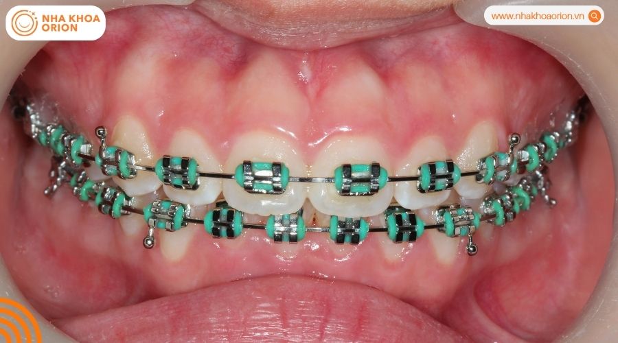 Lựa chọn dựa theo t&igrave;nh trạng răng miệng