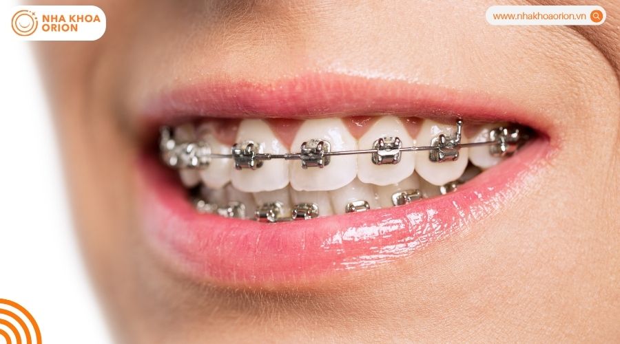 Lựa chọn theo hiệu quả chỉnh nha