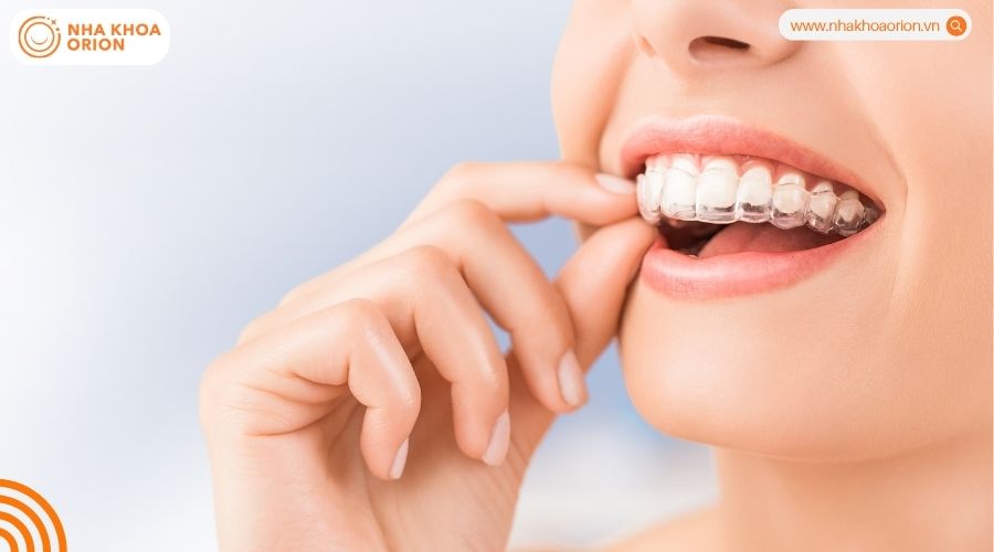 Lựa chọn theo nhu cầu thẩm mỹ