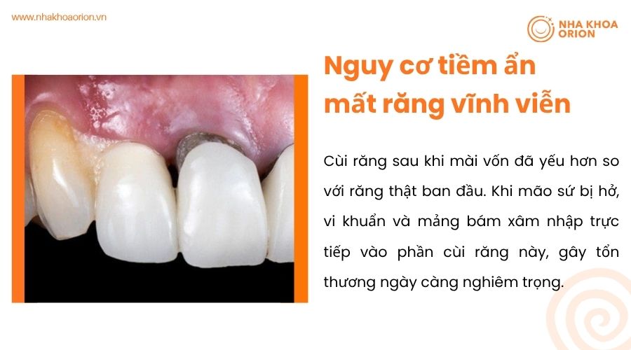 Nguy cơ tiềm ẩn mất răng vĩnh viễn