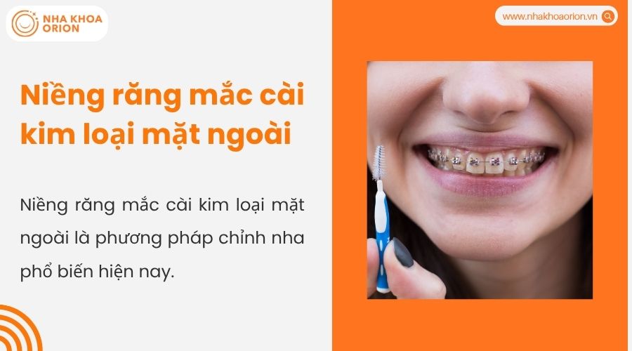 Niềng răng mắc c&agrave;i kim loại mặt ngo&agrave;i
