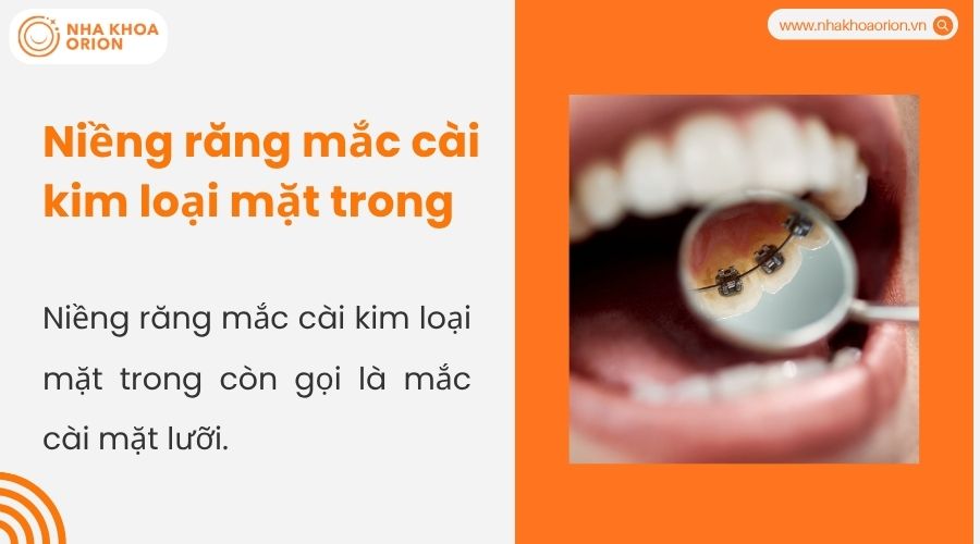 Niềng răng mắc c&agrave;i kim loại mặt trong