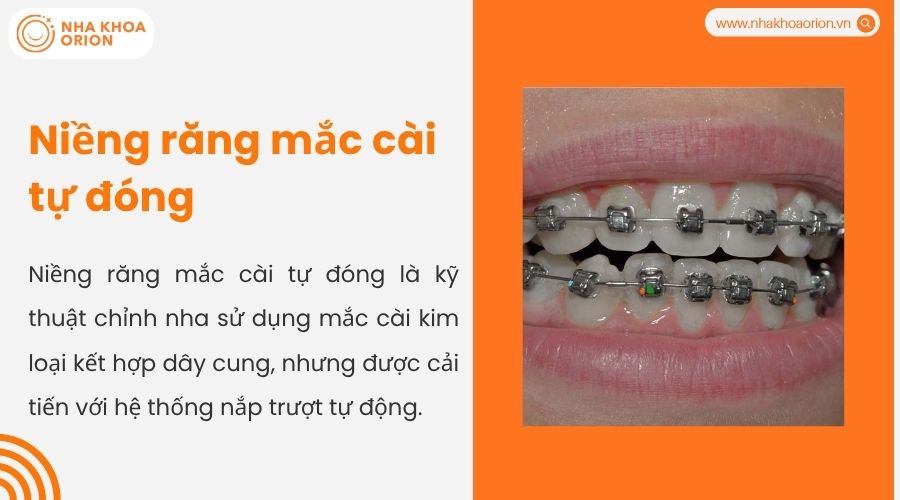 Niềng răng mắc c&agrave;i kim loại tự buộc&nbsp;