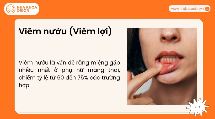 Vi&ecirc;m nướu (Vi&ecirc;m lợi)