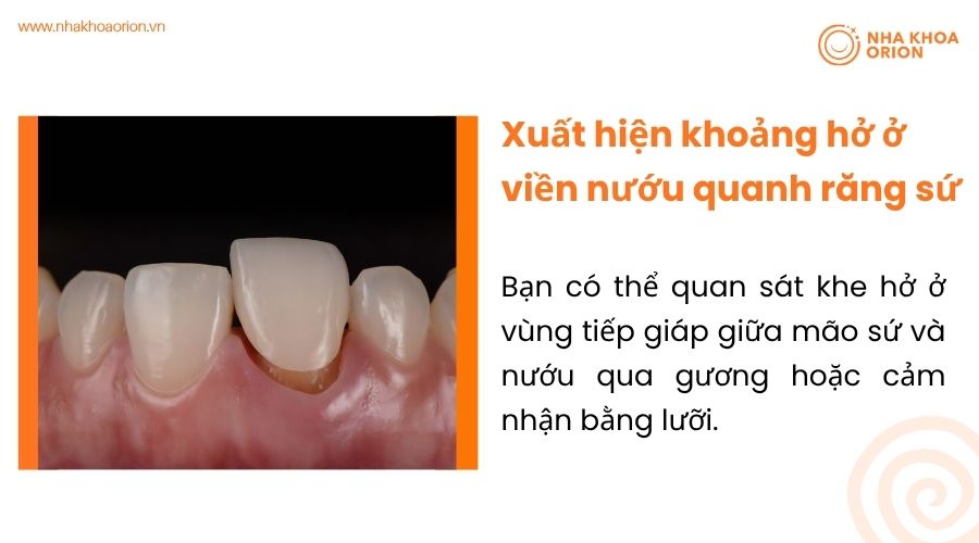 Xuất hiện khoảng hở ở viền nướu quanh răng sứ