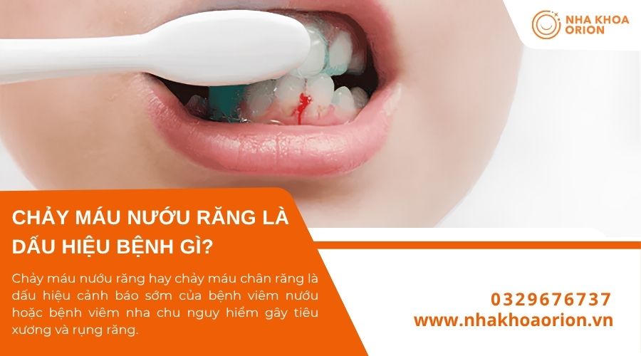 Chảy m&aacute;u nướu răng l&agrave; dấu hiệu của bệnh g&igrave;