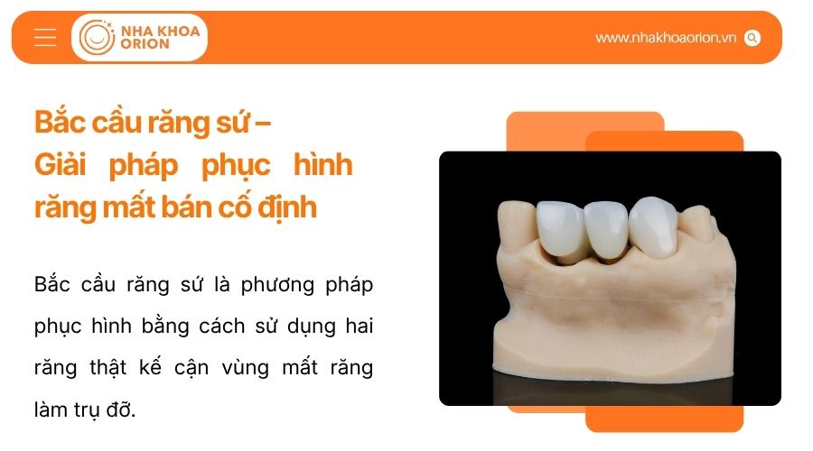 Bắc cầu răng sứ - Giải ph&aacute;p phục h&igrave;nh răng mất b&aacute;n cố định