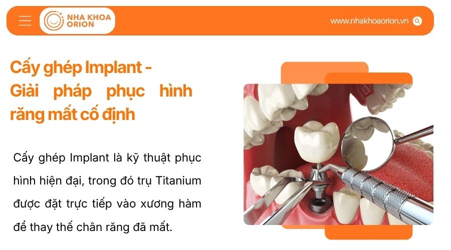 Cấy gh&eacute;p Implant - Giải ph&aacute;p phục h&igrave;nh răng mất cố định