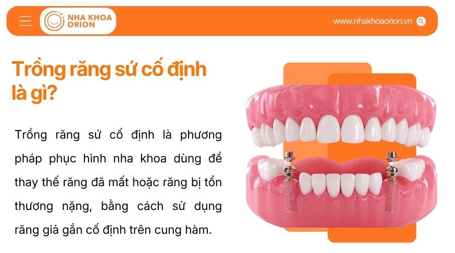 Trồng răng sứ cố định l&agrave; g&igrave;
