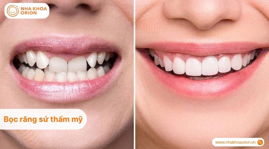 Bọc răng sứ c&oacute; thể cải thiện thẩm mỹ răng khểnh trong một số trường hợp ph&ugrave; hợp