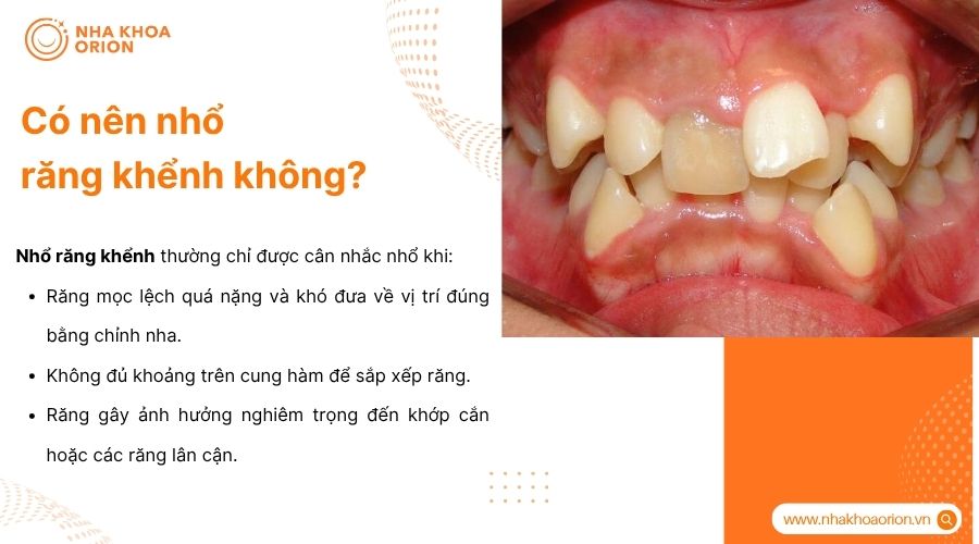 Nhổ răng khểnh chỉ c&acirc;n nhắc khi lệch nặng, thiếu chỗ hoặc ảnh hưởng khớp cắn