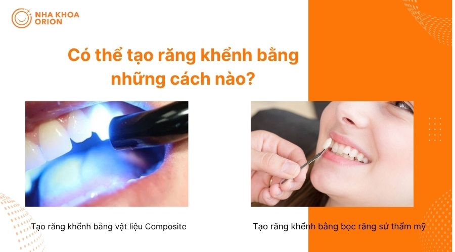 C&aacute;c phương ph&aacute;p nha khoa thẩm mỹ c&oacute; thể hỗ trợ tạo h&igrave;nh răng khểnh theo mong muốn