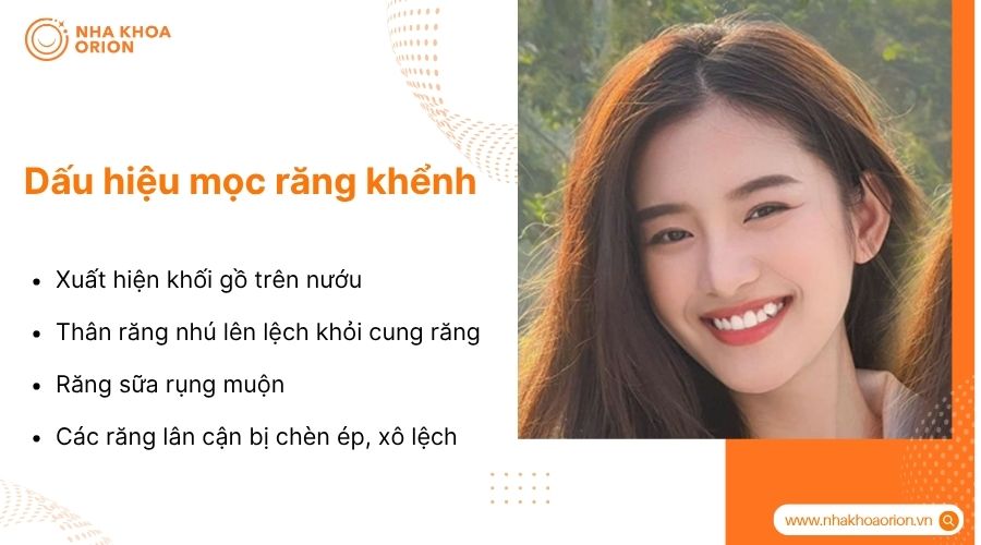 Răng nanh mọc lệch l&agrave; dấu hiệu điển h&igrave;nh của răng khểnh