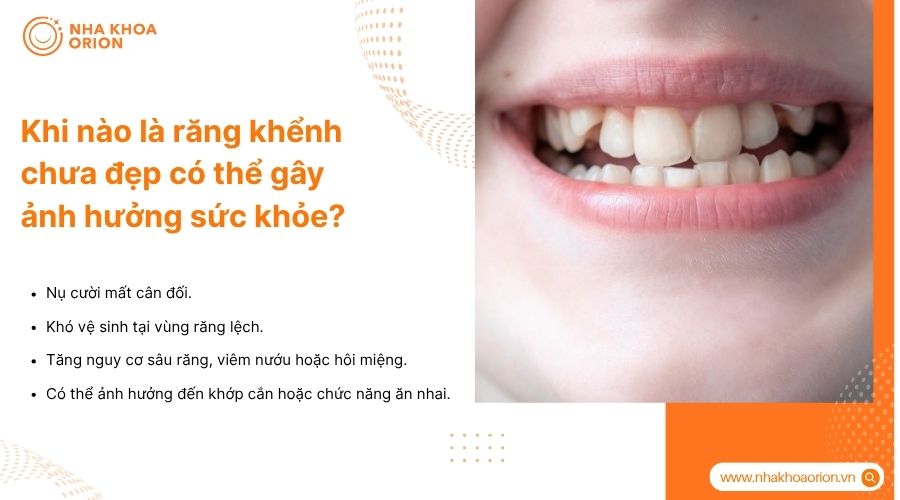 Răng khểnh mọc lệch nhiều c&oacute; thể g&acirc;y mất thẩm mỹ, kh&oacute; vệ sinh v&agrave; rối loạn khớp cắn.
