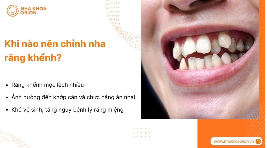 Niềng răng khểnh khi lệch nhiều, ảnh hưởng khớp cắn, thẩm mỹ v&agrave; vệ sinh