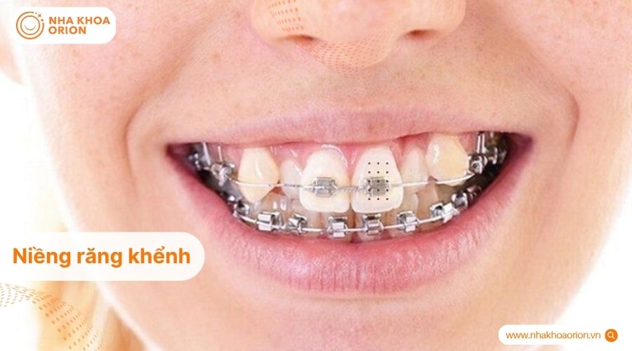 Niềng răng gi&uacute;p đưa răng khểnh về đ&uacute;ng vị tr&iacute; tr&ecirc;n cung h&agrave;m