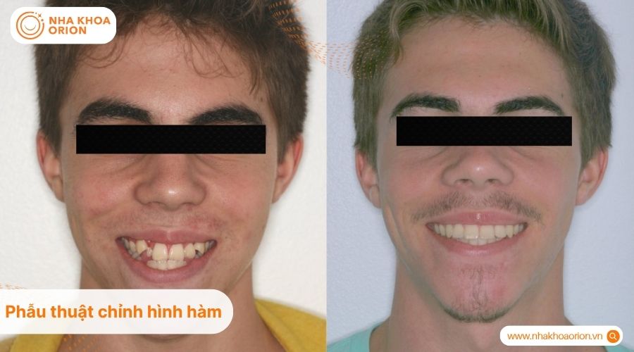 Phẫu thuật chỉnh h&igrave;nh h&agrave;m được chỉ định khi răng khểnh đi k&egrave;m sai lệch xương h&agrave;m