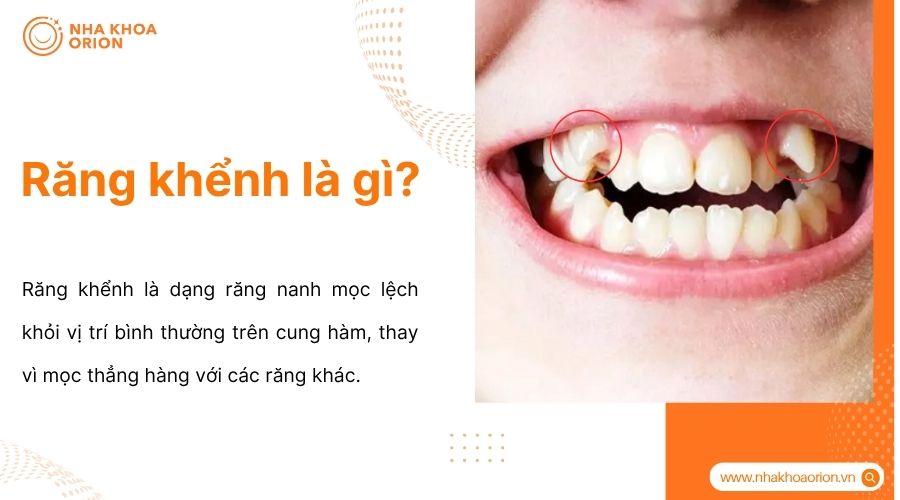 Răng khểnh l&agrave; răng nanh mọc lệch khỏi vị tr&iacute; chuẩn tr&ecirc;n cung h&agrave;m