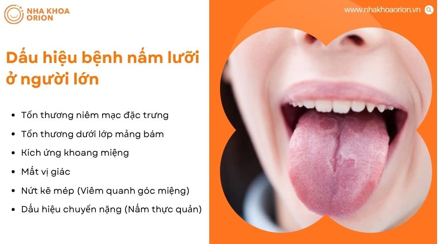Nấm lưỡi gây mảng trắng, đau rát, mất vị giác và có thể lan xuống thực quản