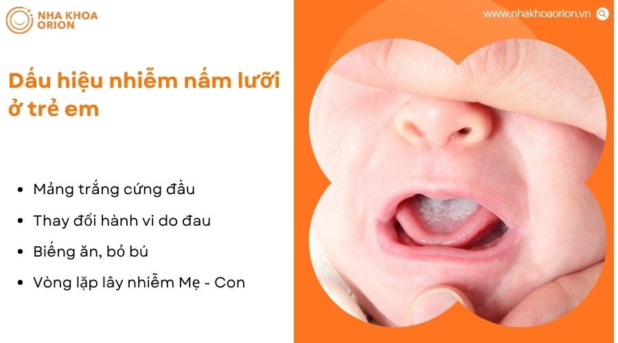 Nấm lưỡi ở trẻ gây mảng trắng, đau rát, quấy khóc và biếng ăn khi bú