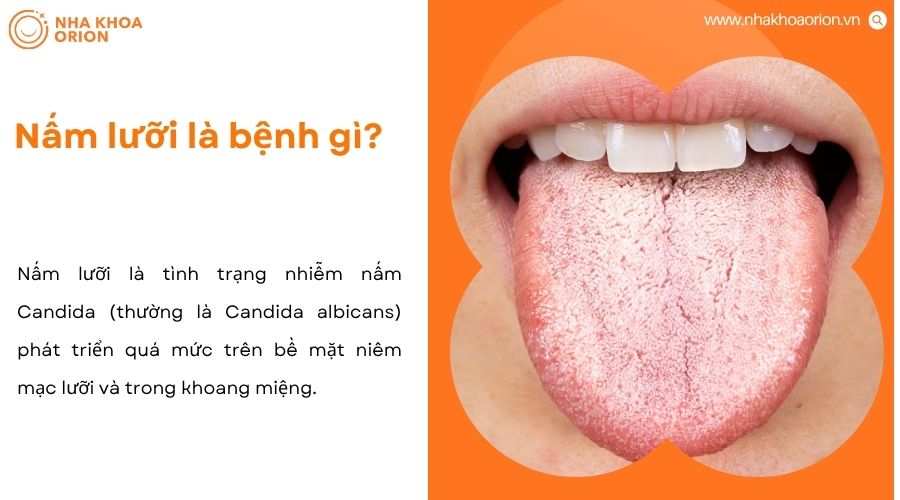 Nấm lưỡi là tình trạng nhiễm nấm Candida phát triển quá mức trong khoang miệng