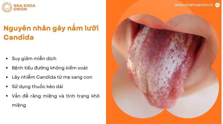 Nấm lưỡi xuất hiện do nhiều yếu tố như miễn dịch yếu, bệnh lý và thói quen sinh hoạt.