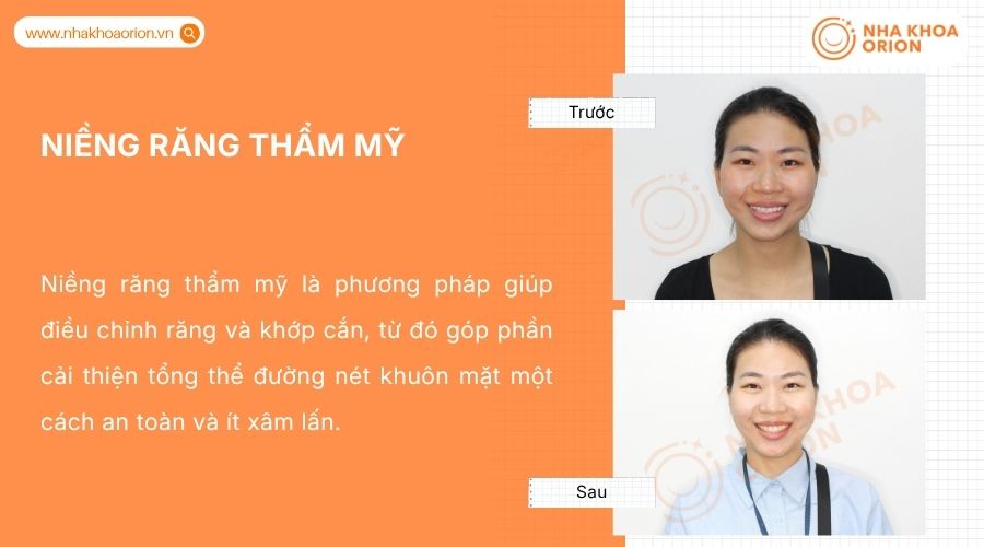 Niềng răng gi&uacute;p chỉnh răng v&agrave; khớp cắn, hỗ trợ cải thiện đường n&eacute;t khu&ocirc;n mặt