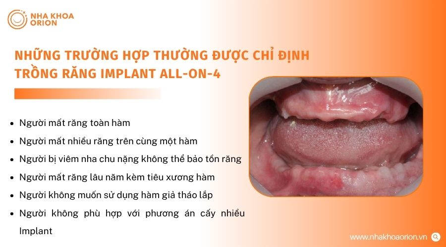Mất răng to&agrave;n h&agrave;m l&agrave; chỉ định phổ biến của cấy gh&eacute;p Implant All on 4