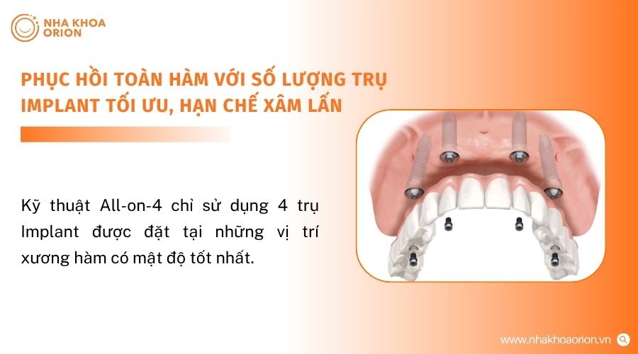 All-on-4 gi&uacute;p kh&ocirc;i phục to&agrave;n bộ cung răng tr&ecirc;n 4 trụ Implant
