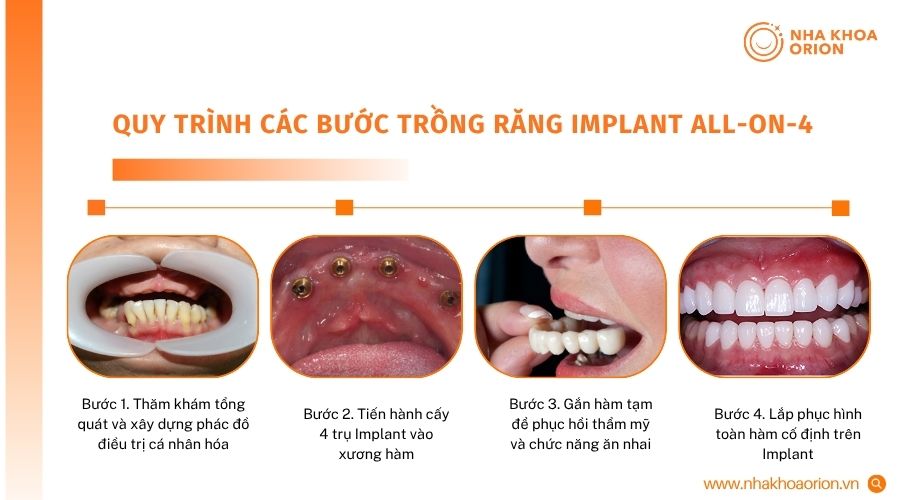 C&aacute;c giai đoạn ch&iacute;nh trong quy tr&igrave;nh phục h&igrave;nh to&agrave;n h&agrave;m bằng Implant All-on-4