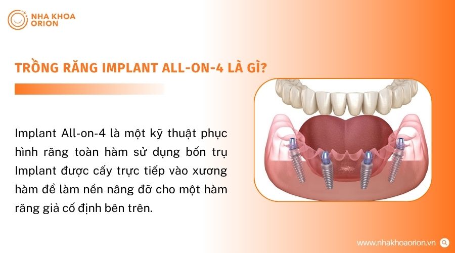 Kỹ thuật All-on-4 sử dụng 4 trụ Implant để phục h&igrave;nh răng to&agrave;n h&agrave;m