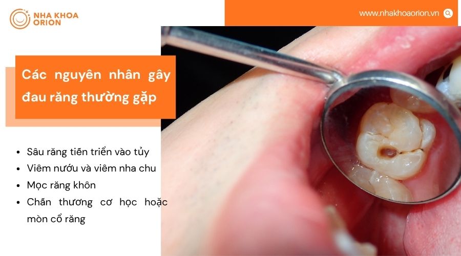 Các nguyên nhân đau răng gồm sâu răng, viêm nướu, mọc răng khôn và mòn cổ răng