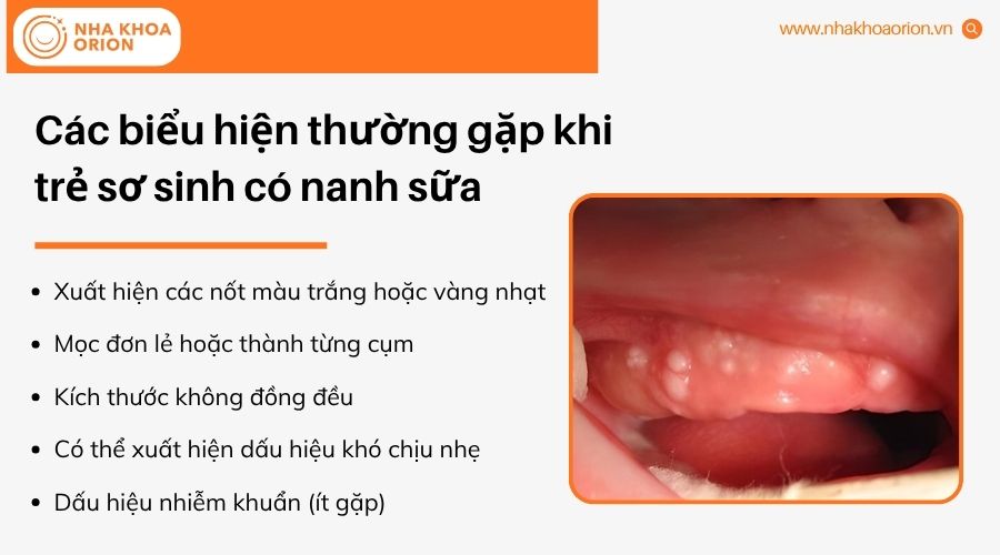 Nanh sữa thường xuất hiện dưới dạng c&aacute;c nốt trắng nhỏ tr&ecirc;n lợi trẻ