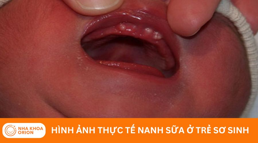 H&igrave;nh ảnh thực tế nanh sữa ở trẻ sơ sinh