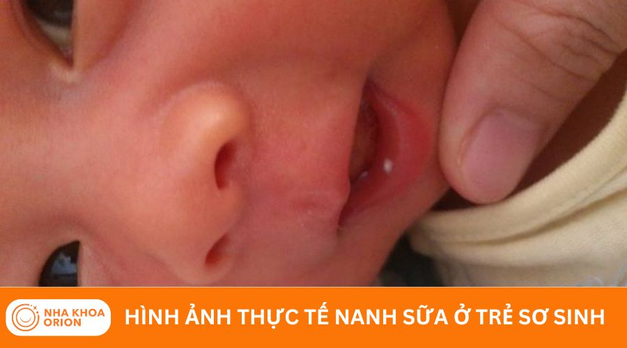 Nanh sữa ở trẻ sơ sinh qua h&igrave;nh ảnh thực tế