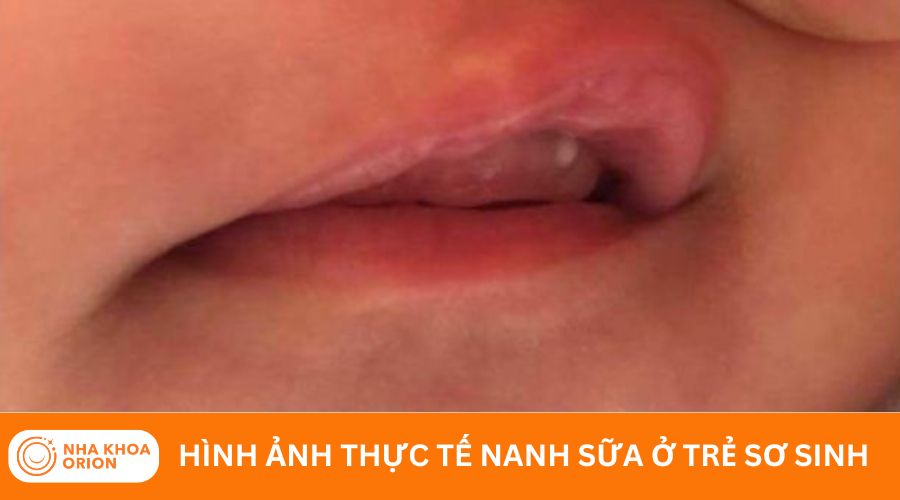 Biểu hiện nanh sữa thường gặp ở trẻ nhỏ