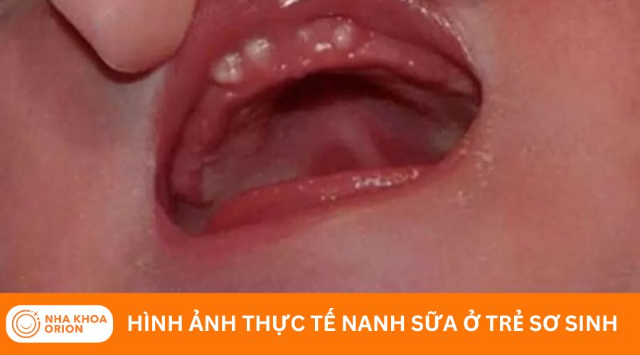 Đốm trắng tr&ecirc;n nướu l&agrave; dấu hiệu nanh sữa ở trẻ sơ sinh