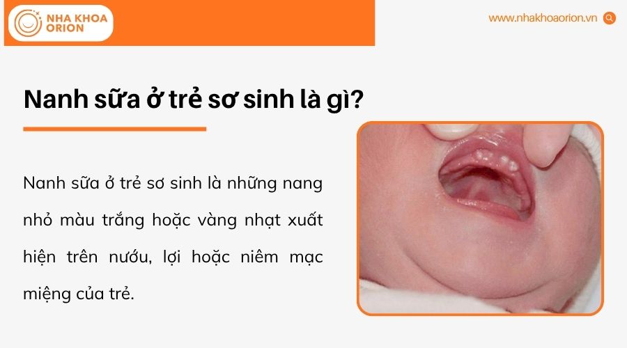Nanh sữa l&agrave; c&aacute;c nang nhỏ m&agrave;u trắng hoặc v&agrave;ng nhạt tr&ecirc;n lợi trẻ sơ sinh