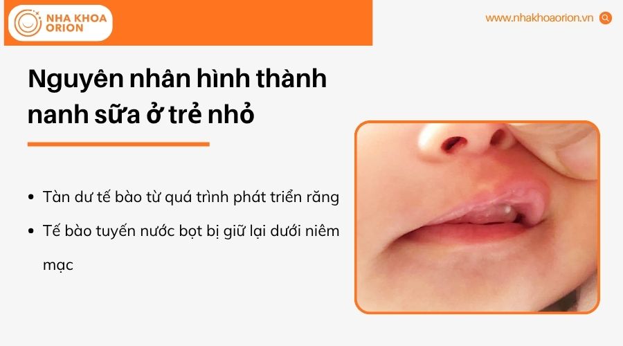 Nang lợi h&igrave;nh th&agrave;nh từ c&aacute;c tế b&agrave;o c&ograve;n lưu lại trong khoang miệng trẻ