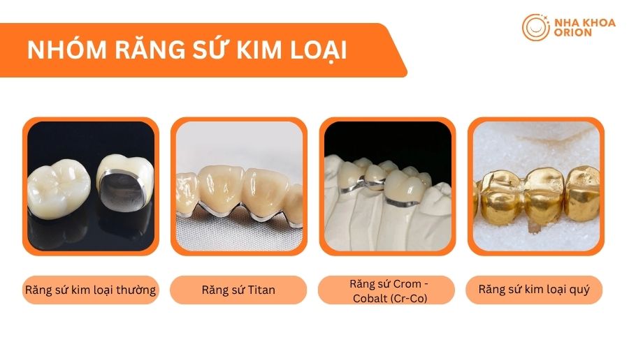 Răng sứ kim loại gồm nhiều dòng khác nhau, phù hợp với từng nhu cầu phục hình