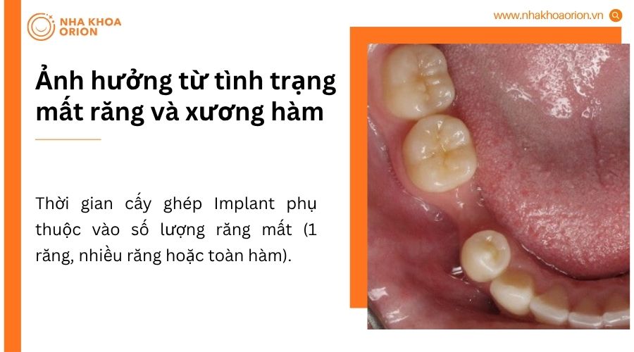 Mất răng l&acirc;u năm v&agrave; ti&ecirc;u xương c&oacute; thể k&eacute;o d&agrave;i thời gian gh&eacute;p Implant do cần gh&eacute;p xương