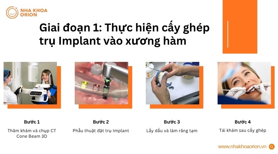 Giai đoạn 1 gồm thăm kh&aacute;m, đặt trụ, l&agrave;m răng tạm v&agrave; t&aacute;i kh&aacute;m sau phẫu thuật