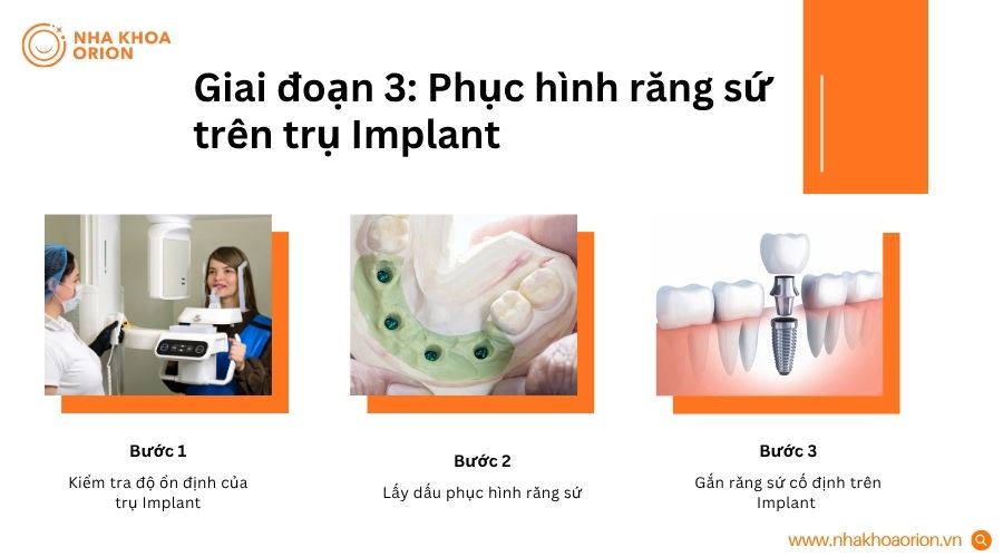 Giai đoạn 3 l&agrave; giai đoạn phục h&igrave;nh răng sứ tr&ecirc;n Implant sau khi trụ đ&atilde; t&iacute;ch hợp ổn định