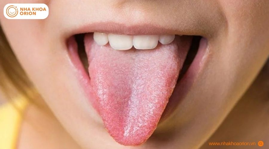 Lưỡi c&oacute; m&agrave;u sắc đồng nhất, bề mặt mịn l&agrave; biểu hiện b&igrave;nh thường