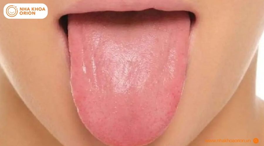 H&igrave;nh ảnh lưỡi ở trạng th&aacute;i khỏe mạnh của người kh&ocirc;ng c&oacute; bệnh l&yacute;