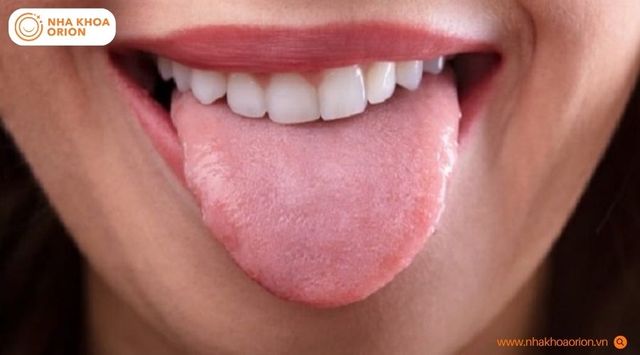 Bề mặt lưỡi hồng h&agrave;i h&ograve;a, kh&ocirc;ng xuất hiện vết lo&eacute;t hay mảng b&aacute;m trắng